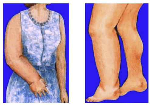 lymphodème