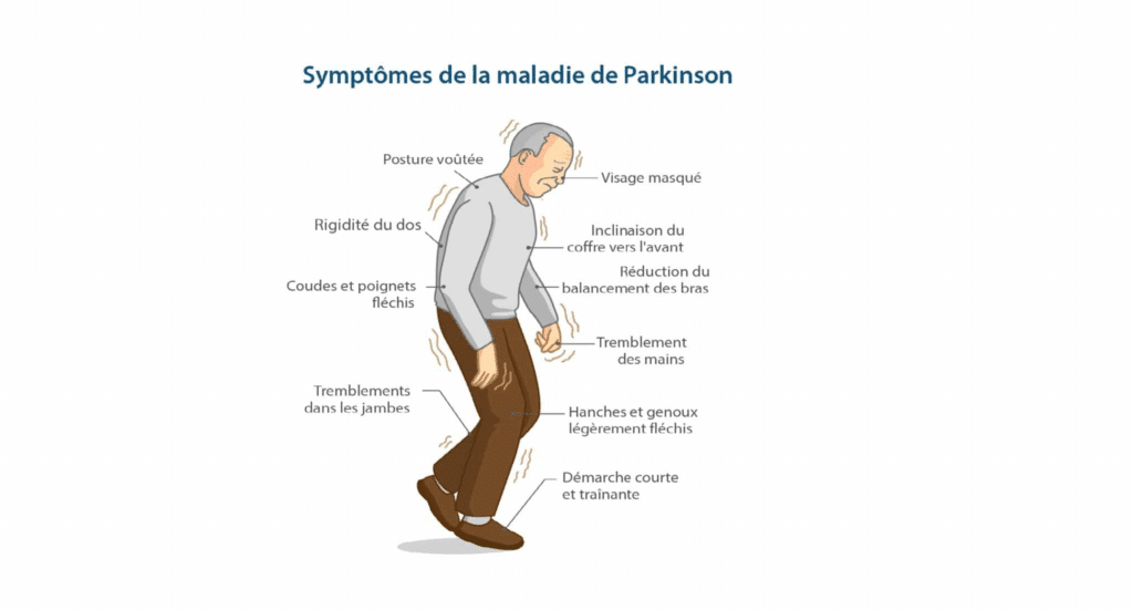 maladie de parkinson