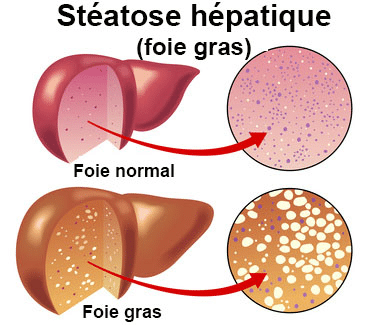 stéatose hépatique