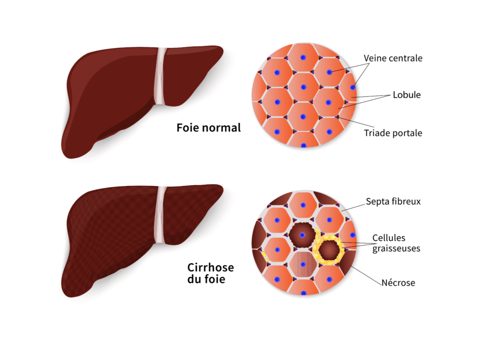 cirrhose